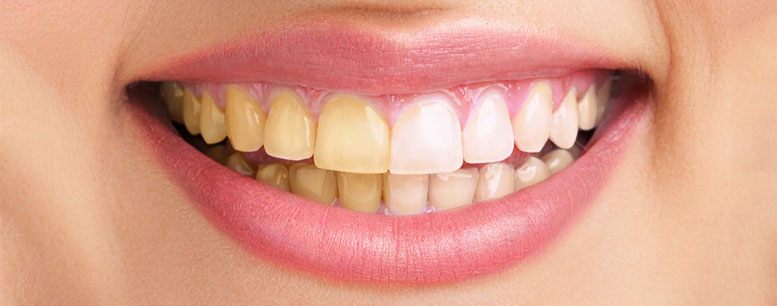 Результат отбеливания зубов